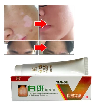 Kinų Medicinos Balta Dėmė Ligos Kremas Pigmento Melanino Skatinti Liniment Odos Vitiligo Leukoplakia Ligos Gydyti 30g